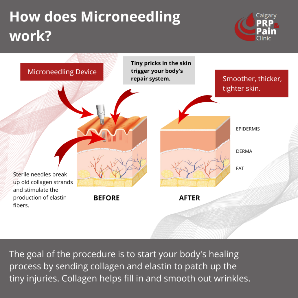 How Does Microneedling Work?